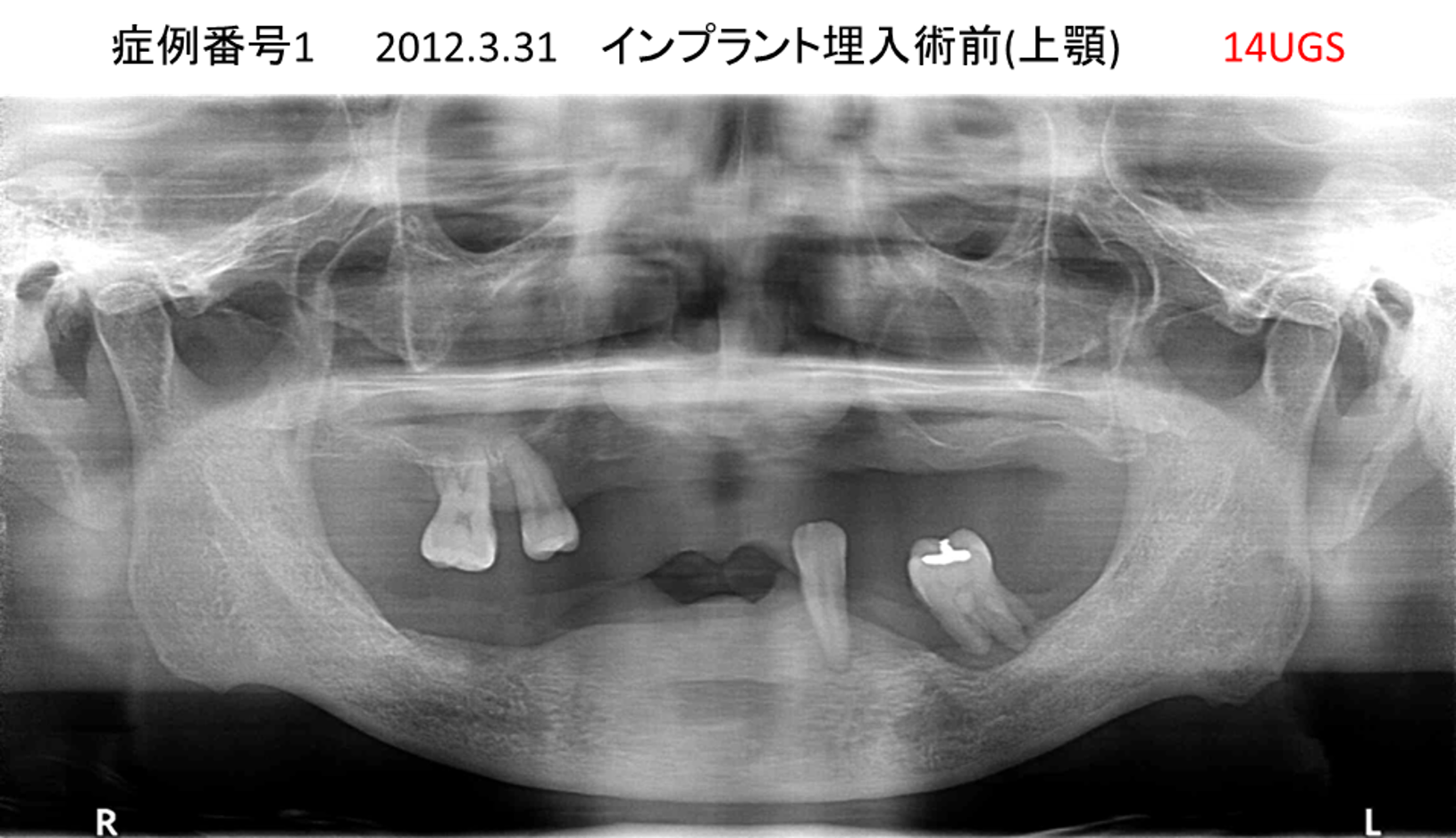インプラント治療前