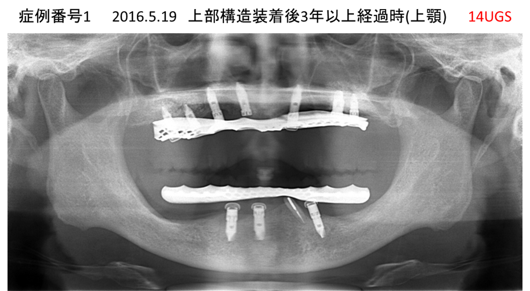 インプラント治療後