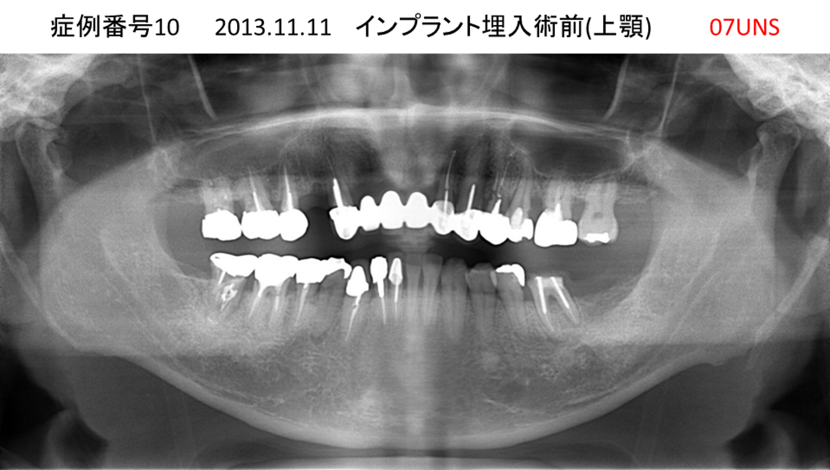 インプラント治療前