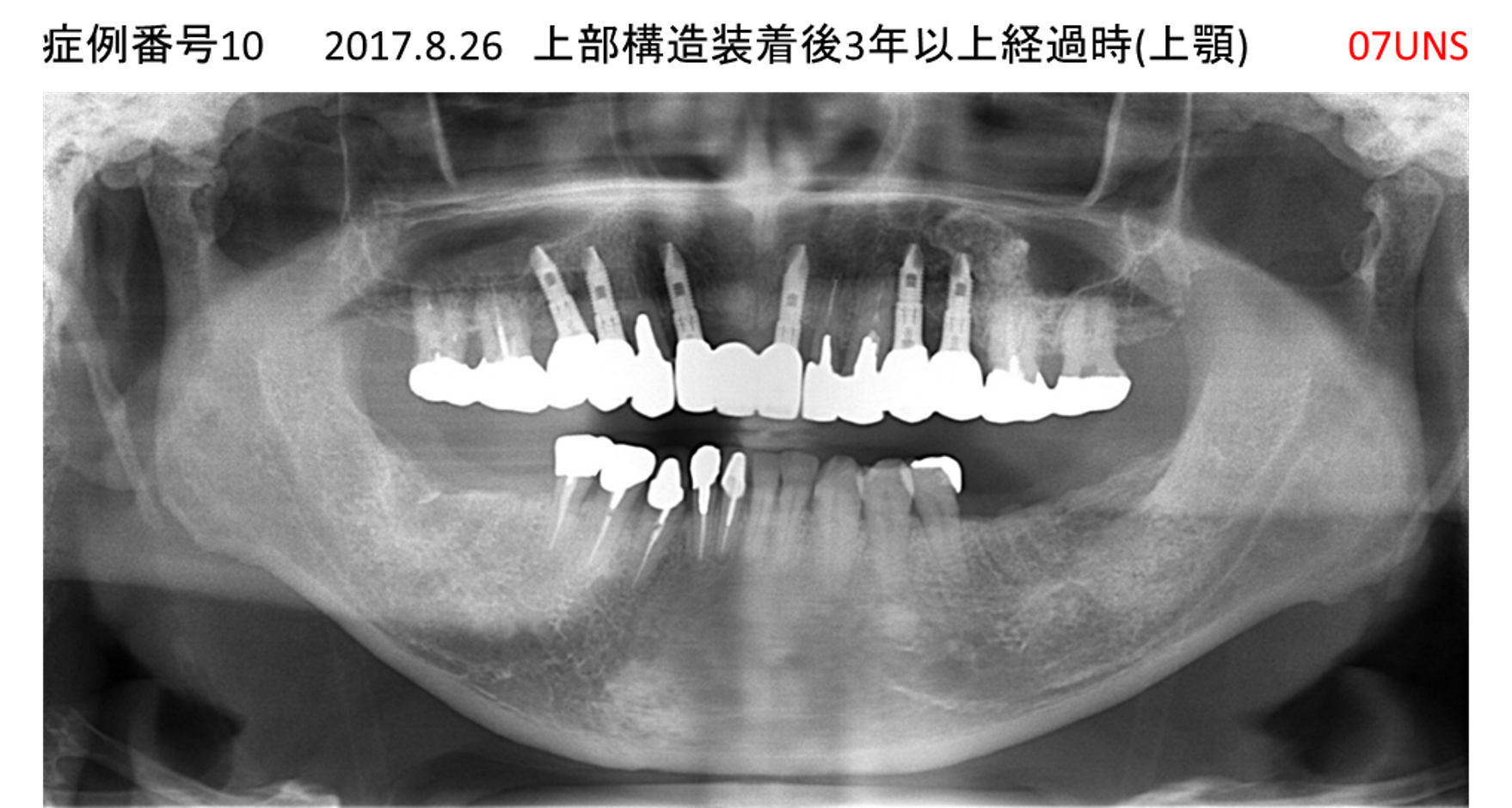 インプラント治療後
