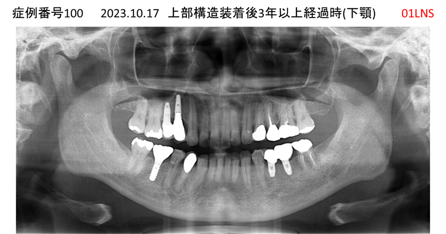 インプラント治療後
