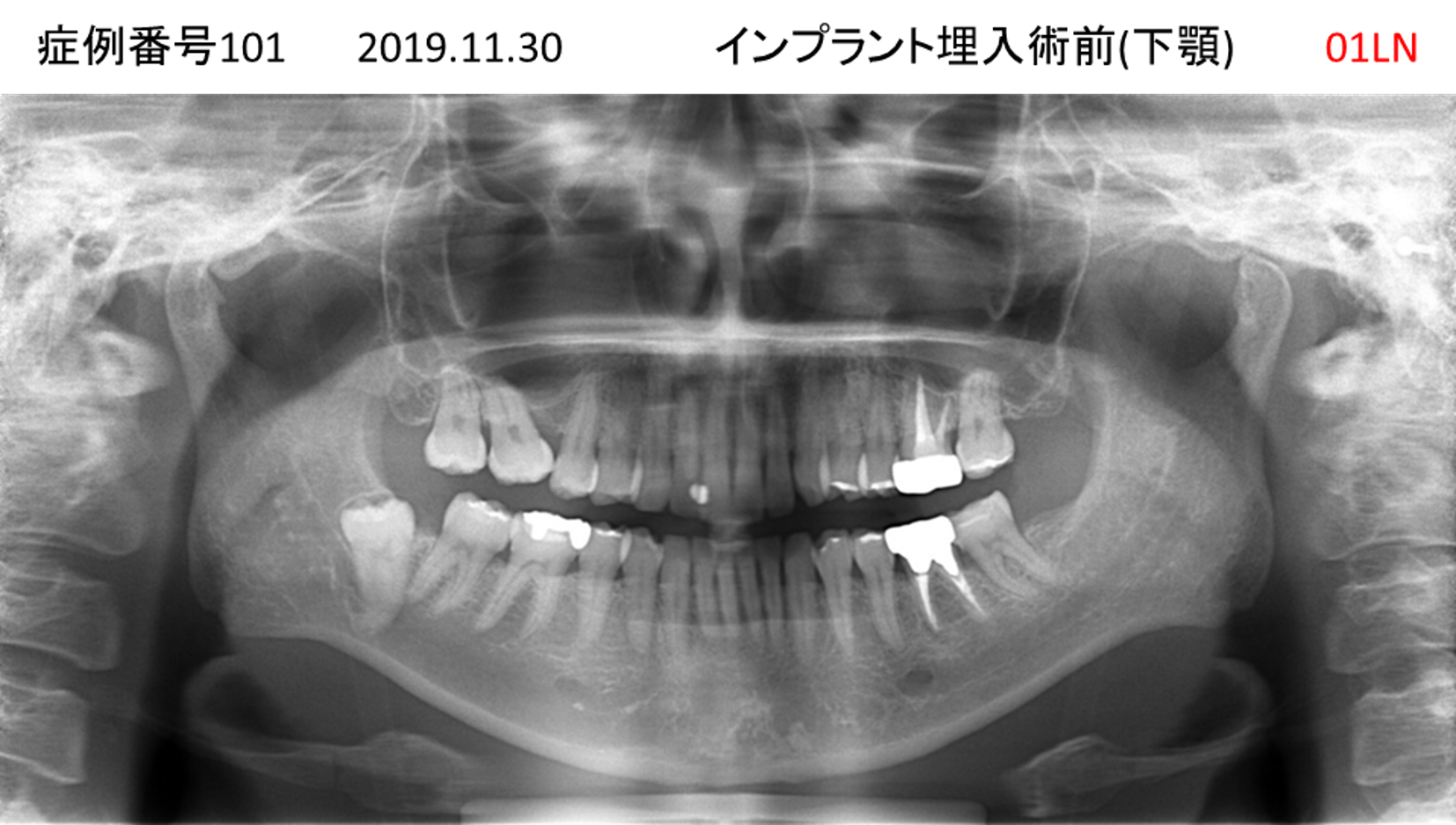 インプラント治療前