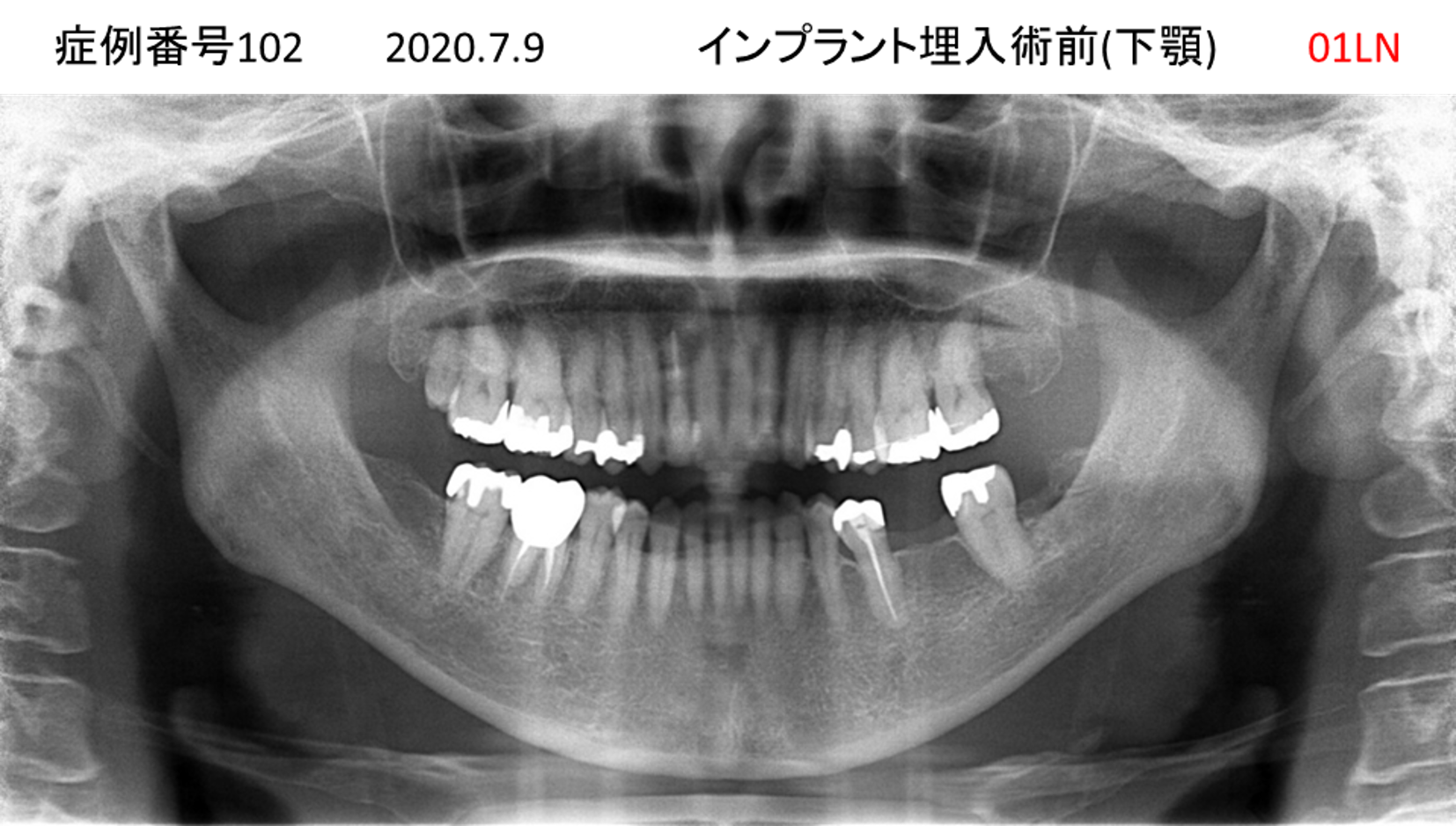 インプラント治療前