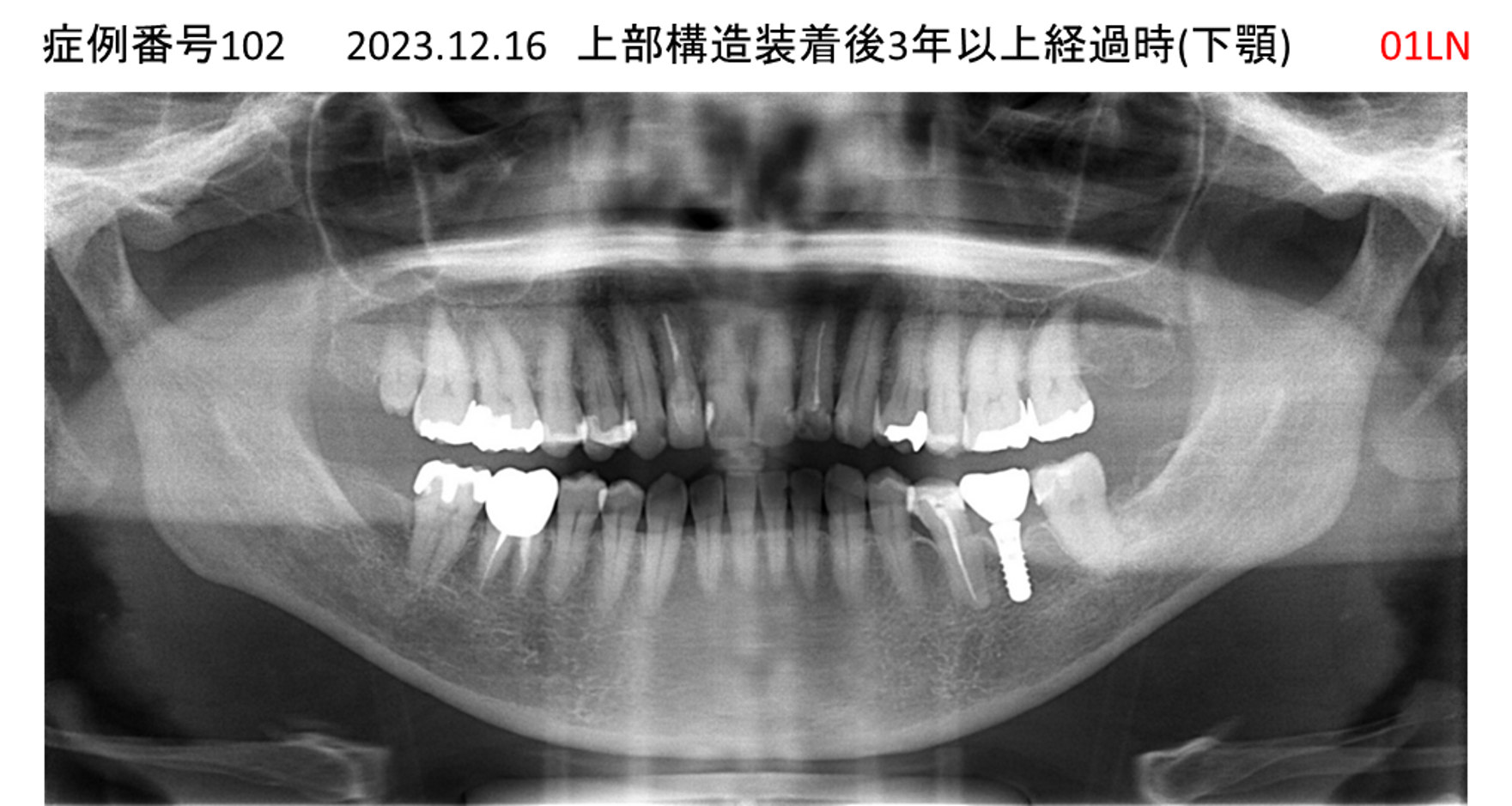 インプラント治療後