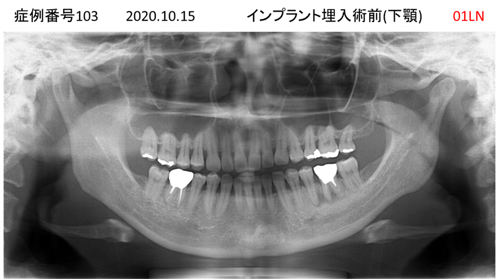 インプラント治療前