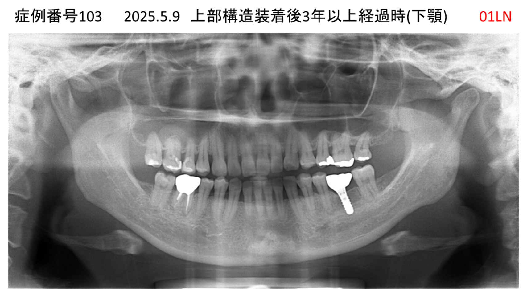 インプラント治療後
