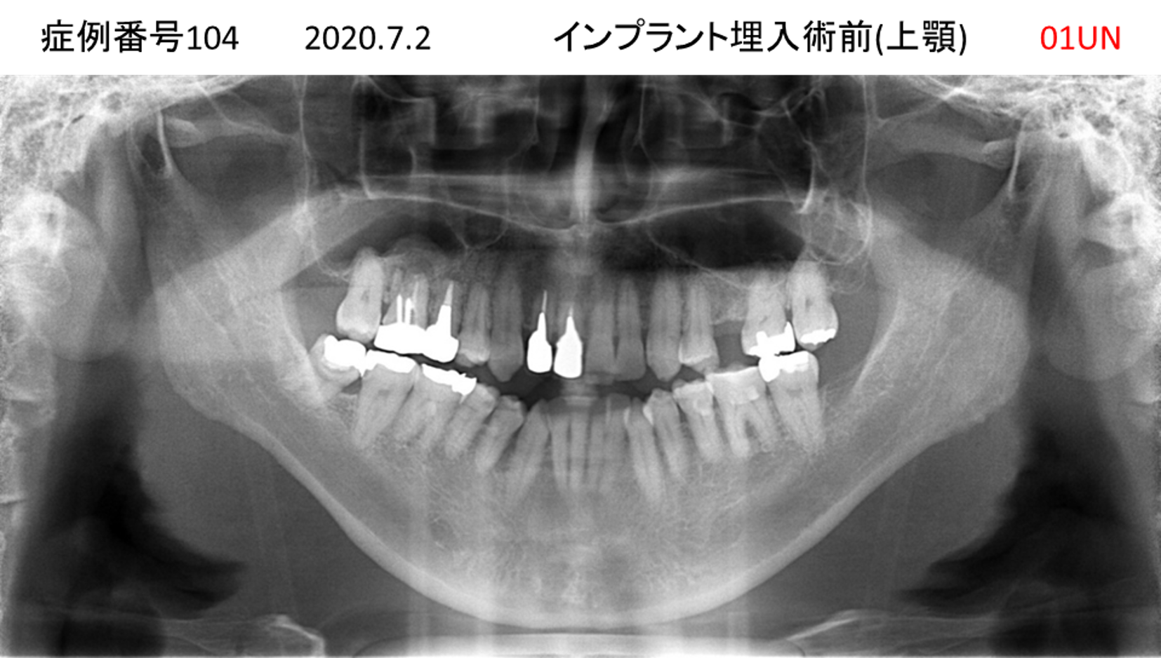 インプラント治療前