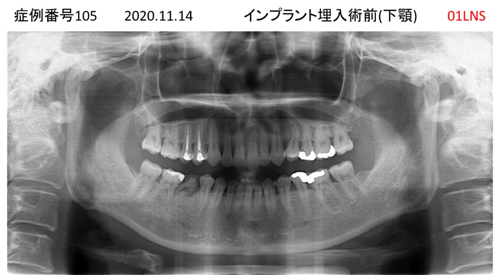 インプラント治療前