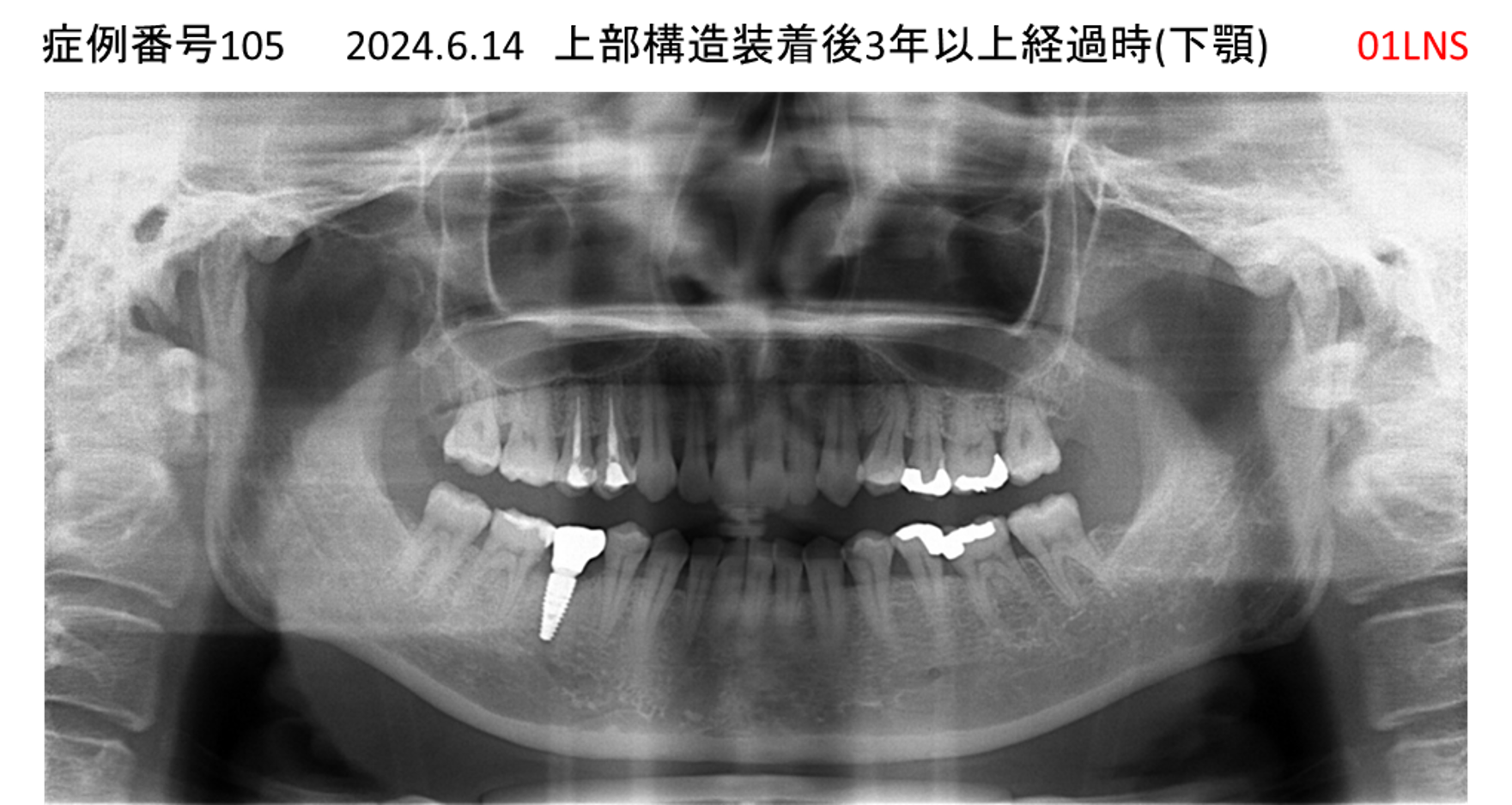 インプラント治療後