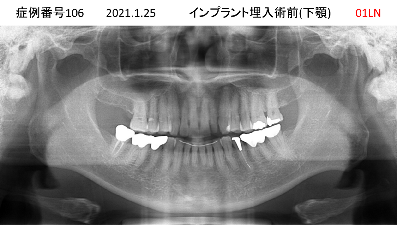 インプラント治療前