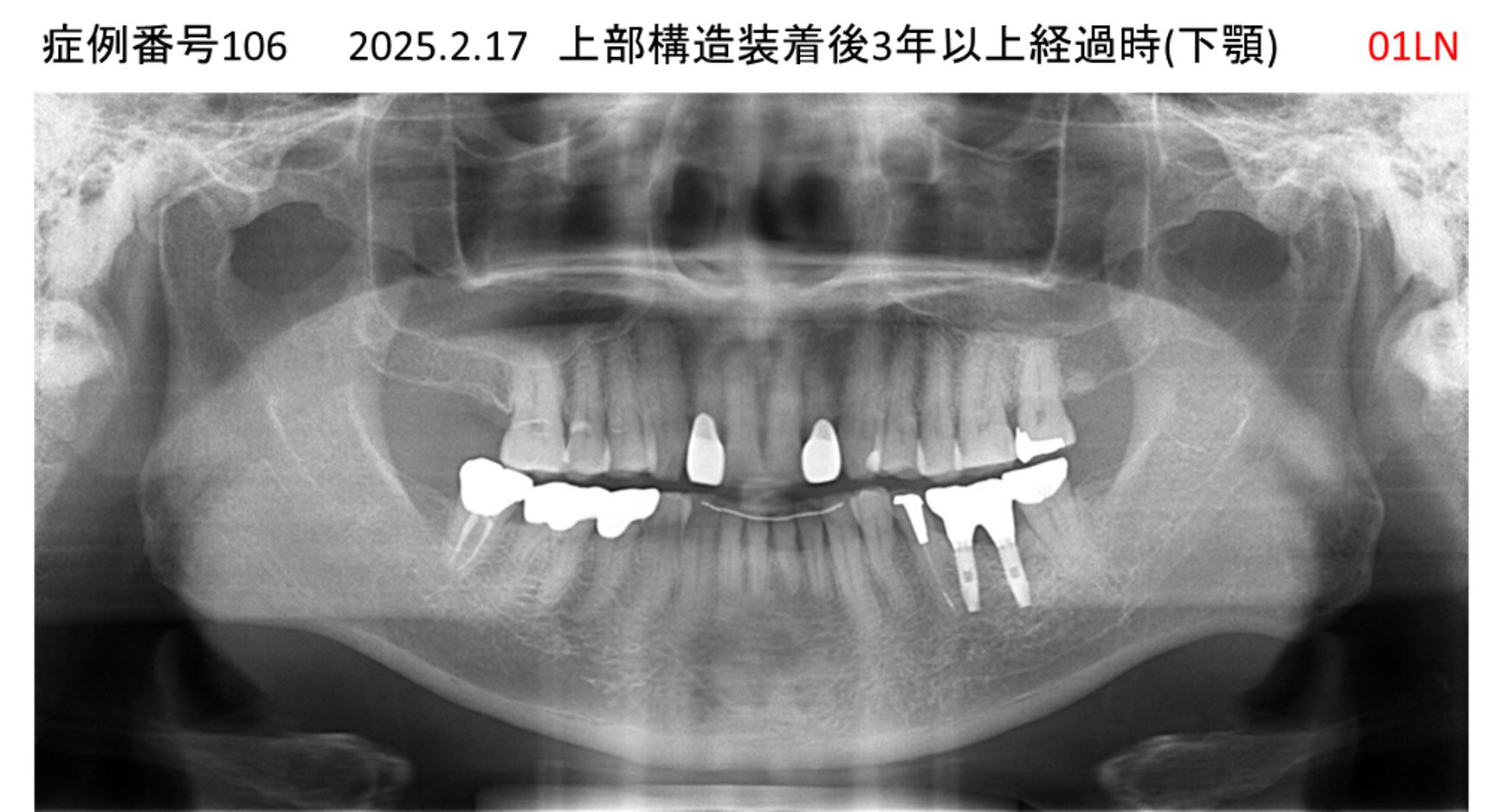 インプラント治療後