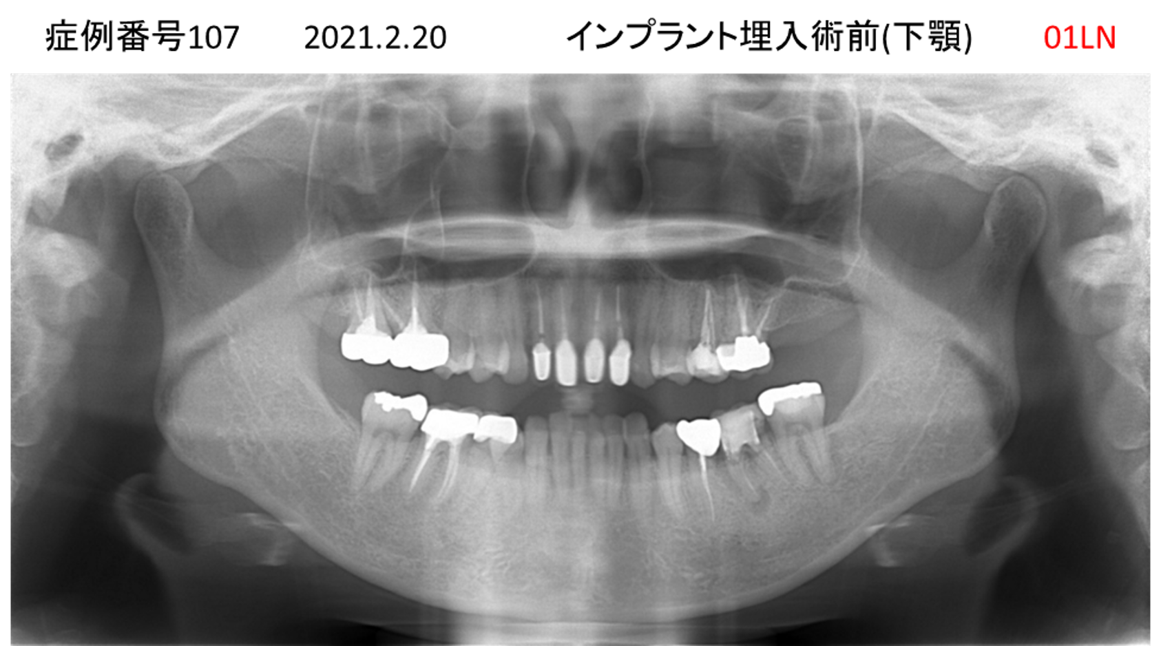インプラント治療前