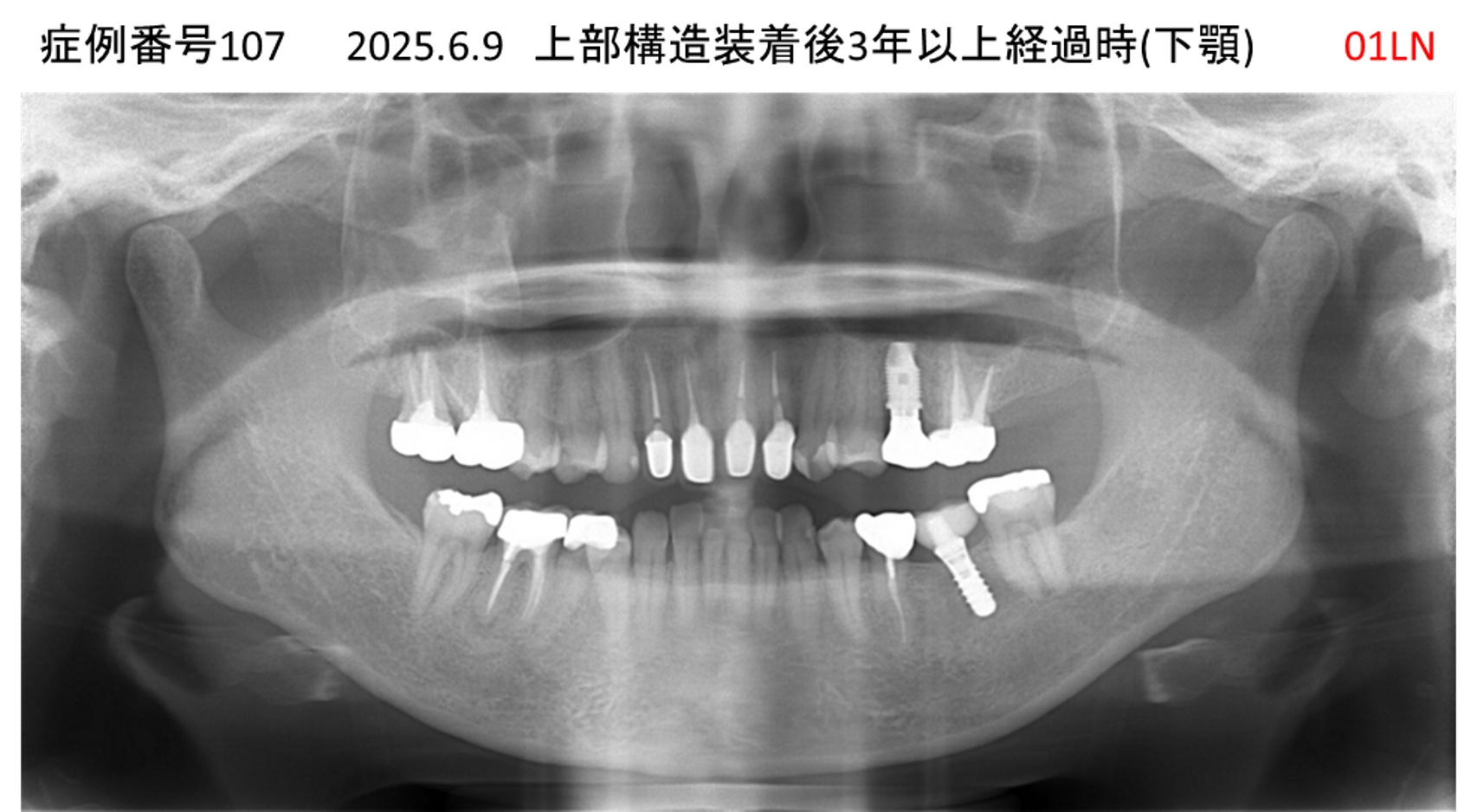 インプラント治療後