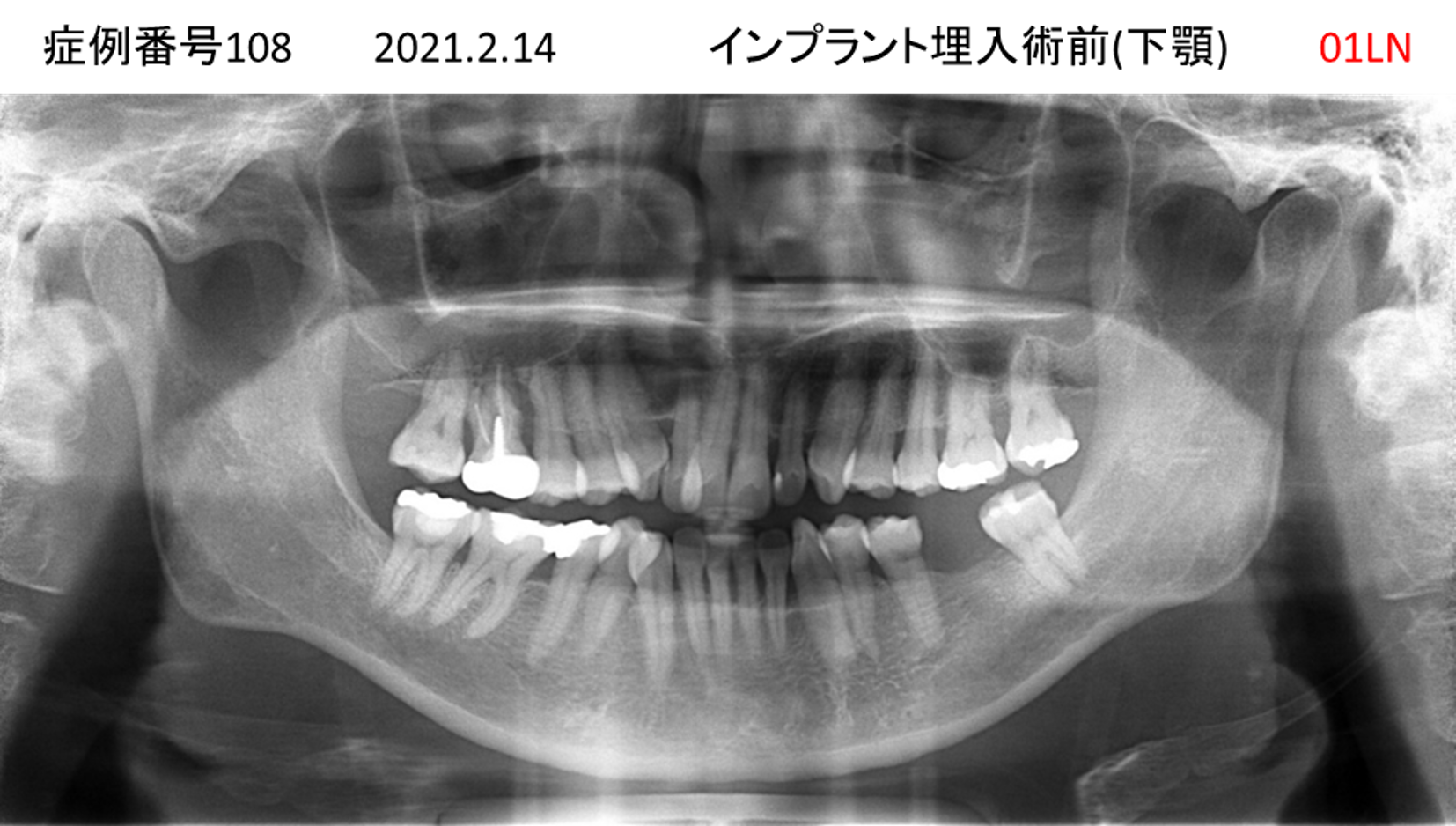 インプラント治療前