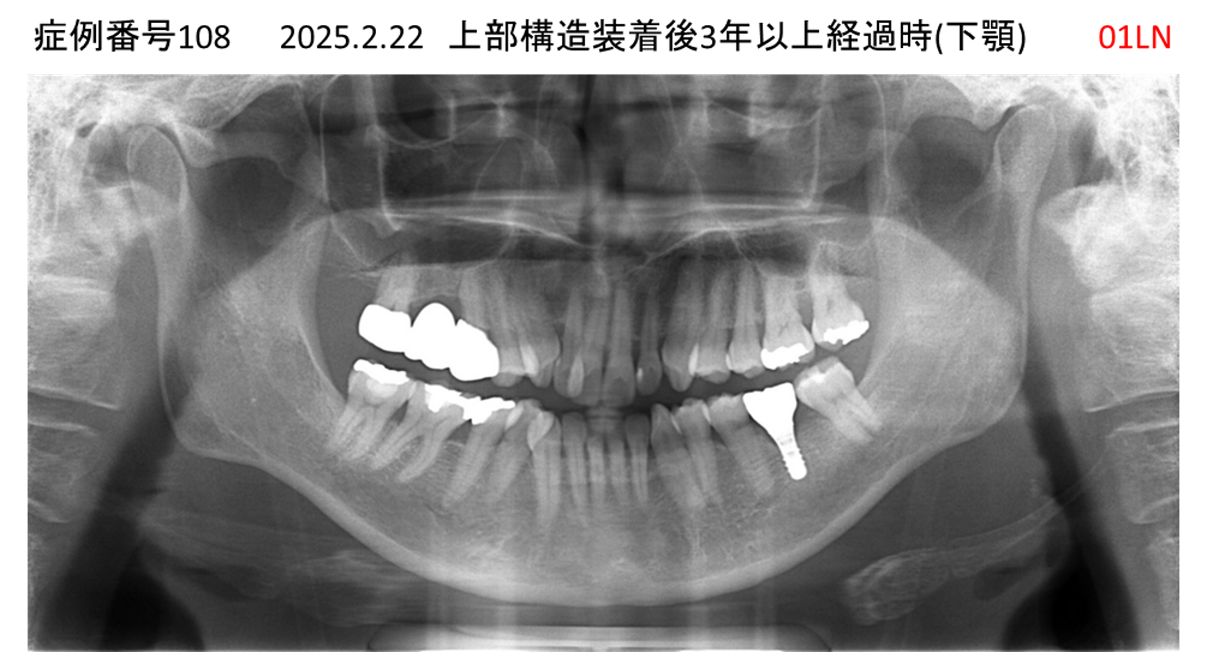 インプラント治療後