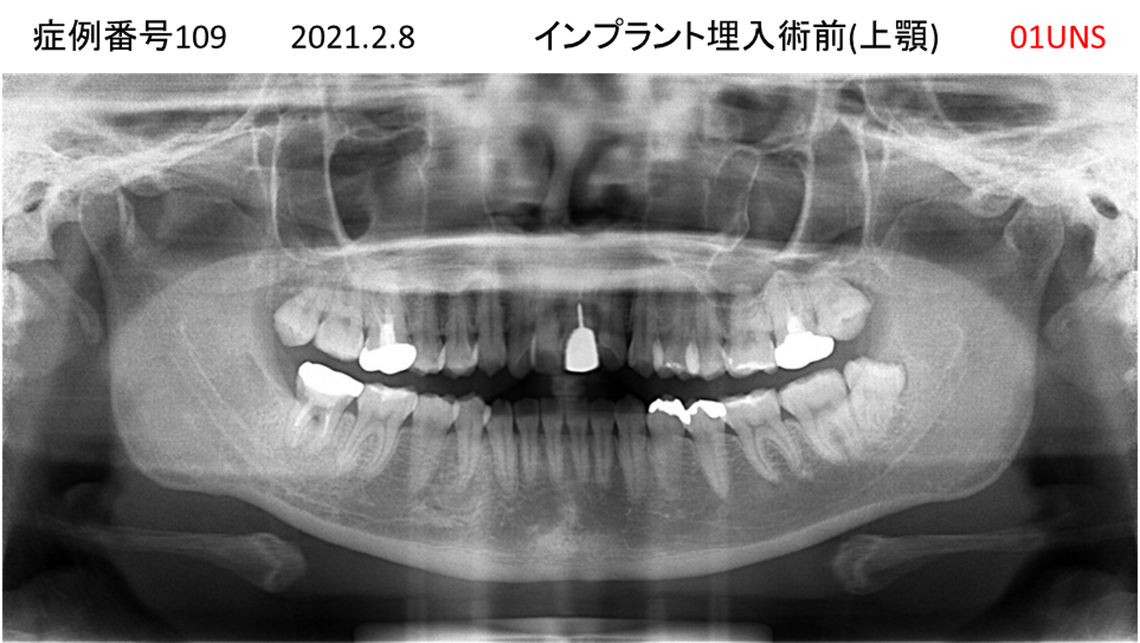 インプラント治療前