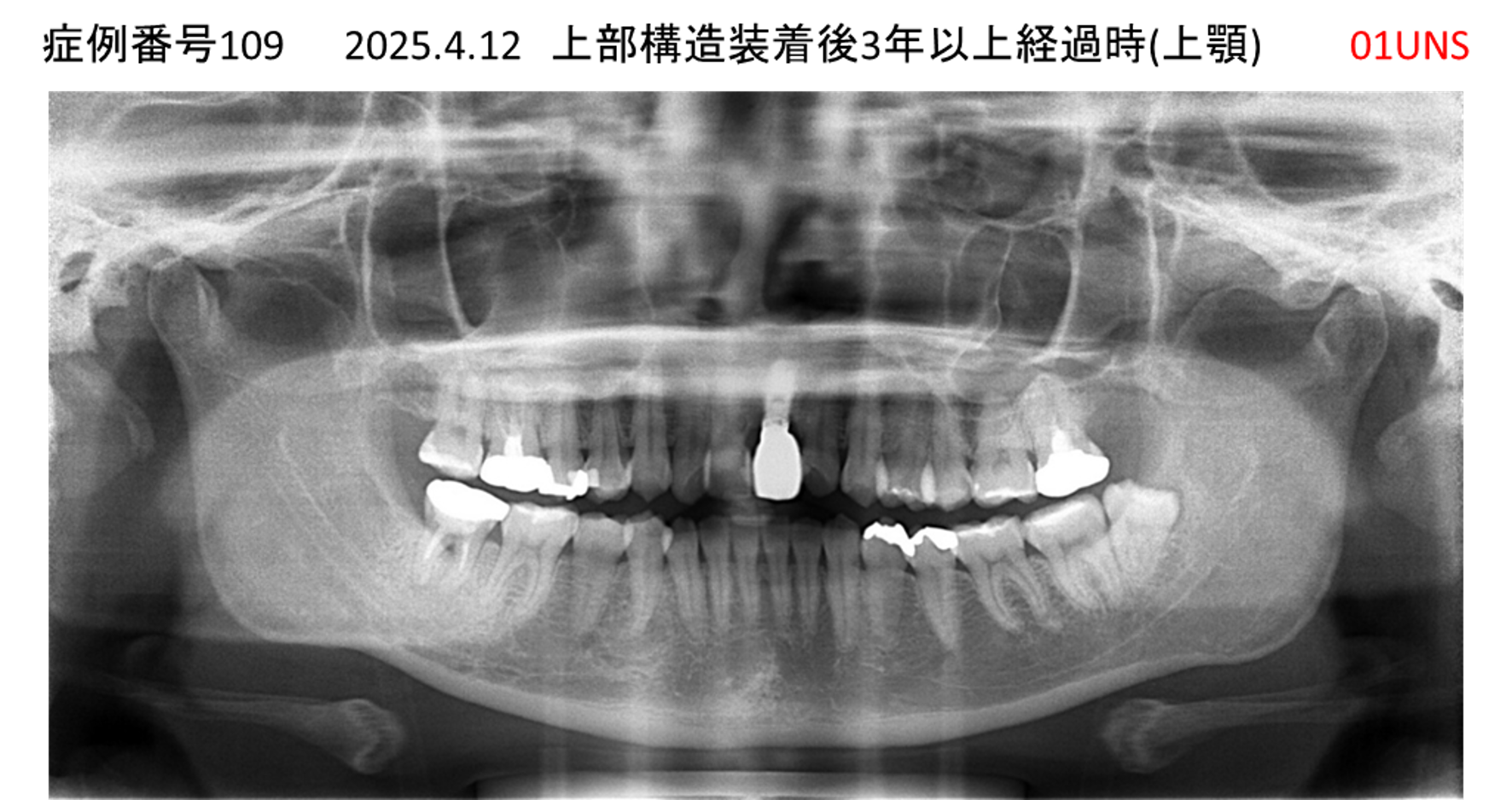 インプラント治療後