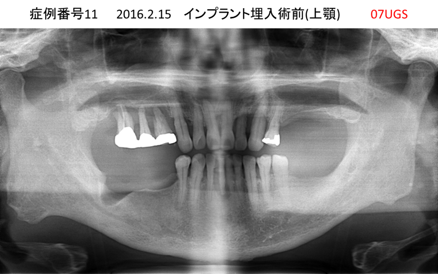 インプラント治療前