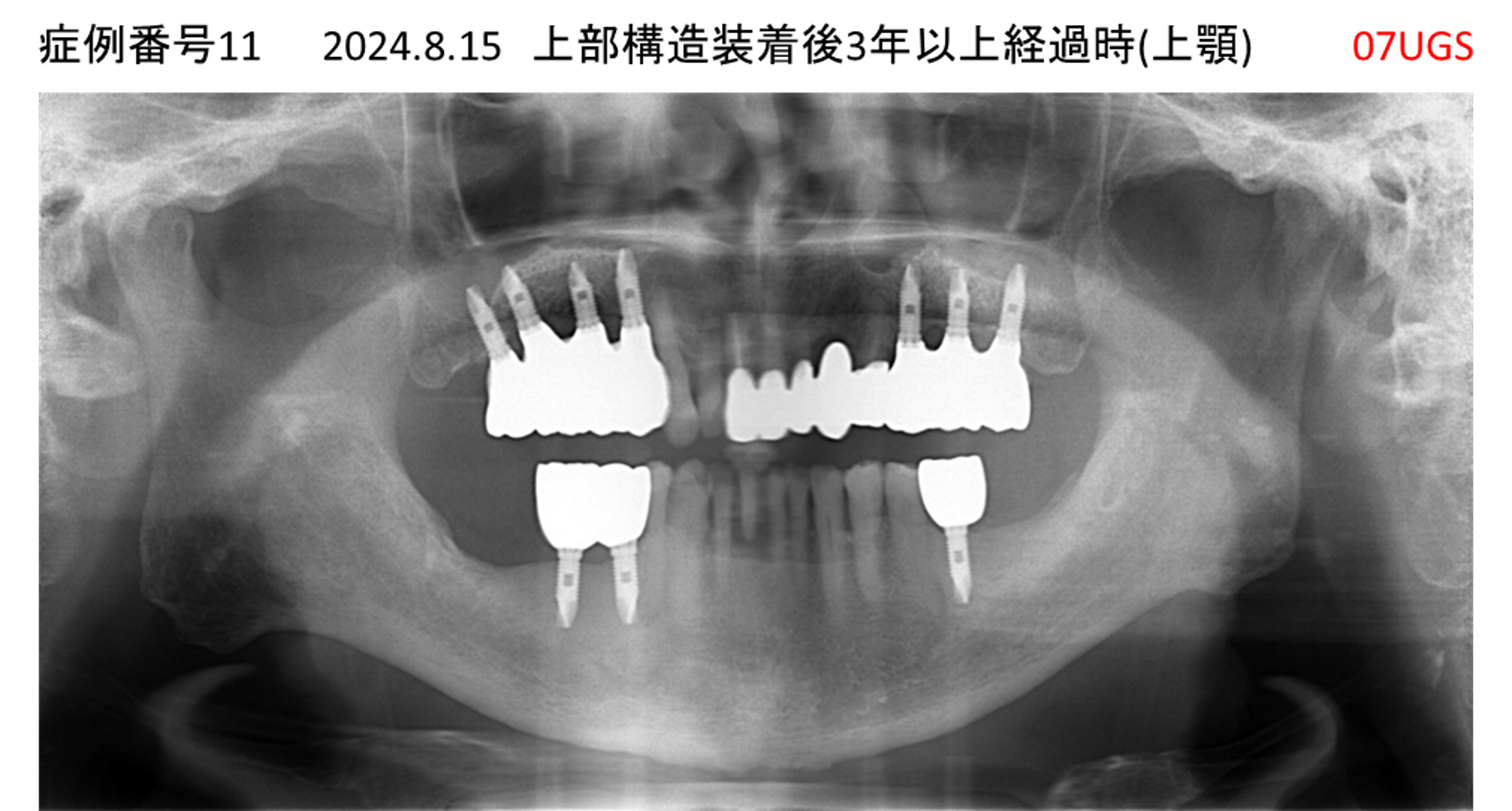 インプラント治療後