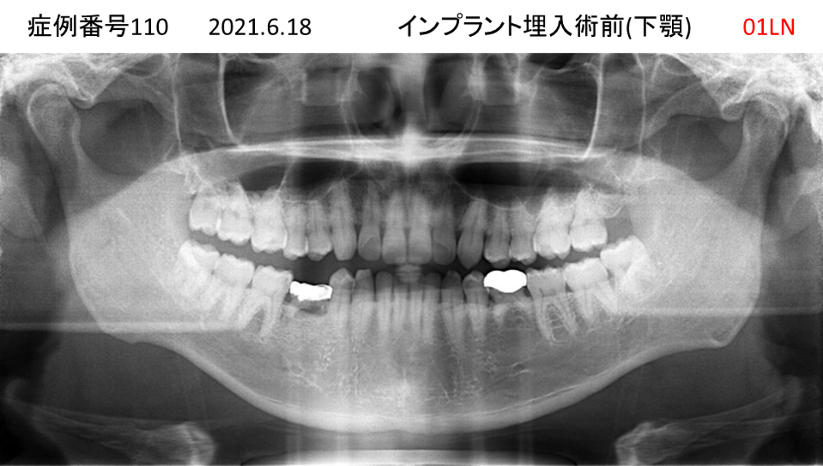 インプラント治療前
