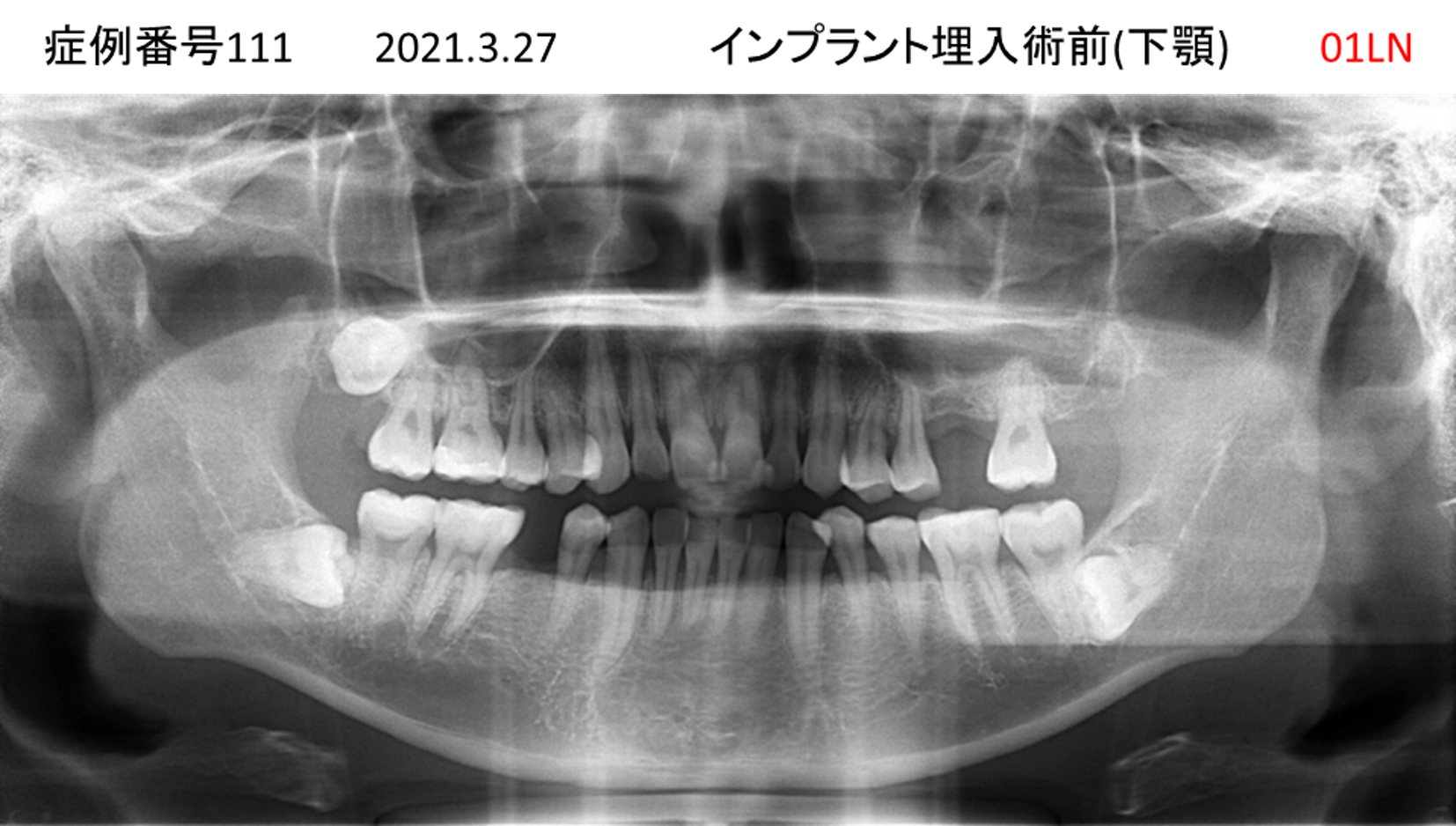 インプラント治療前