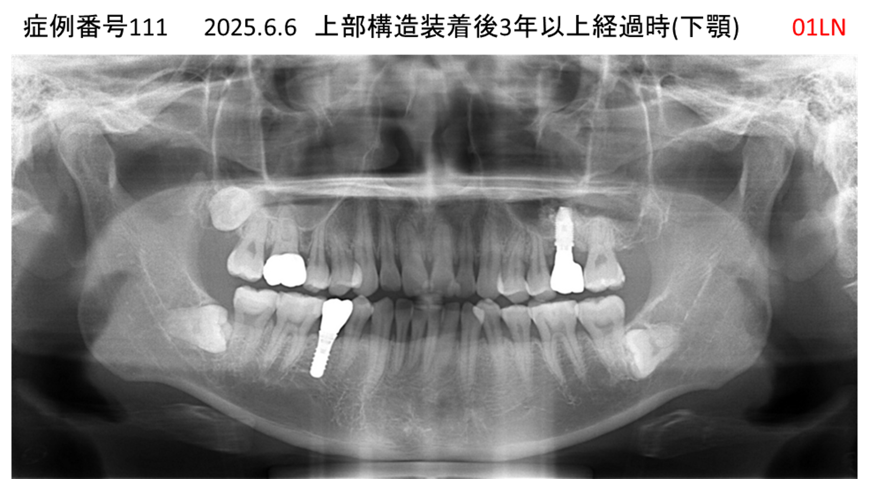 インプラント治療後