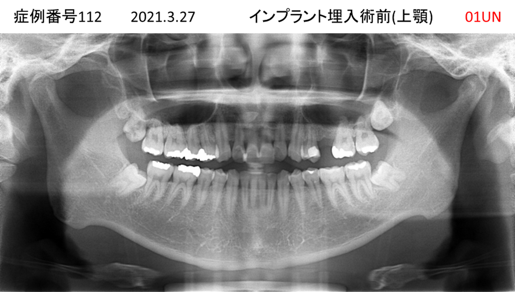 インプラント治療前