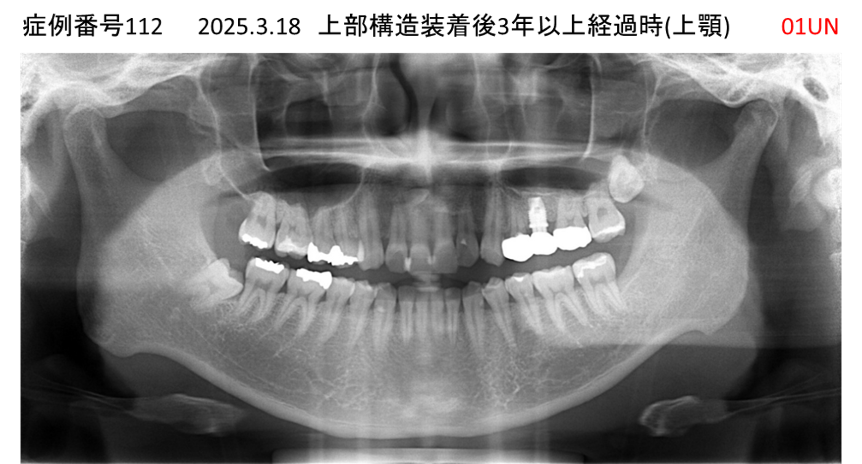 インプラント治療後