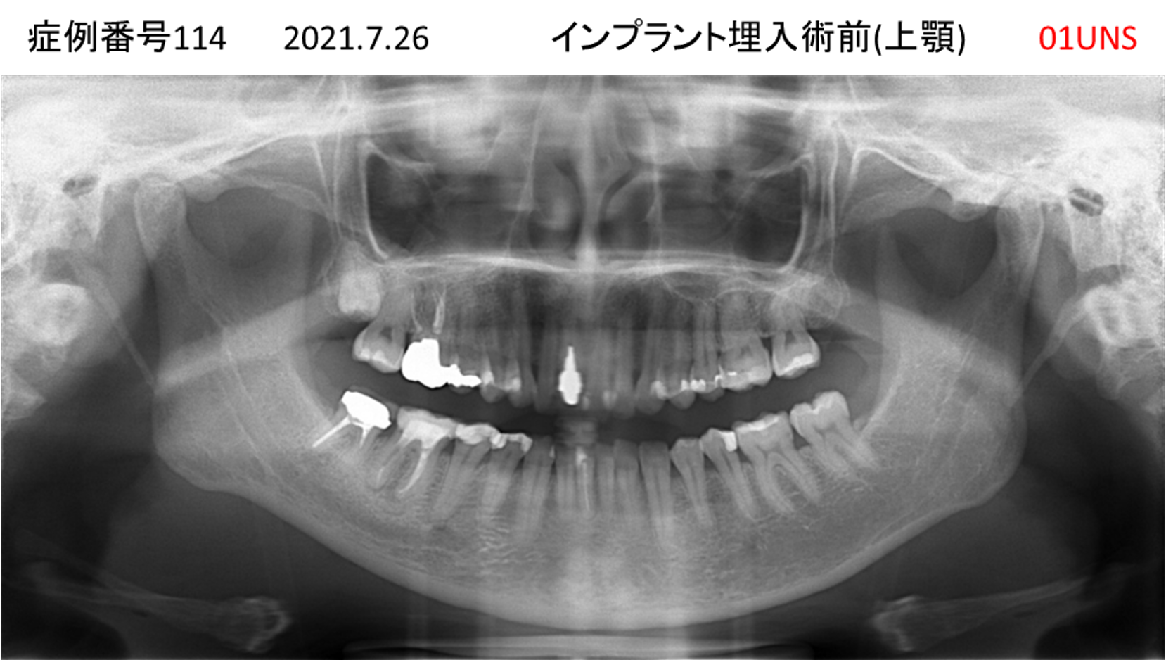 インプラント治療前