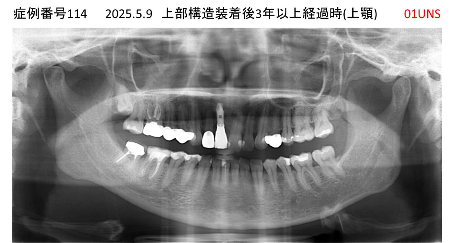 インプラント治療後