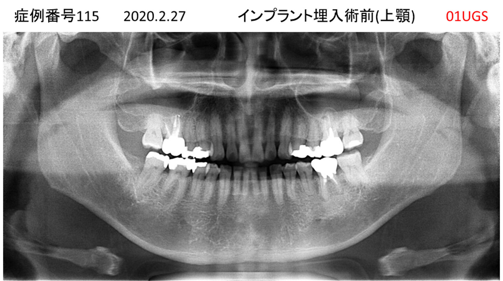インプラント治療前