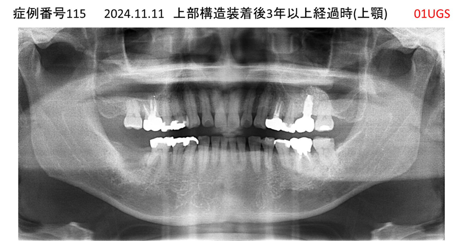 インプラント治療後