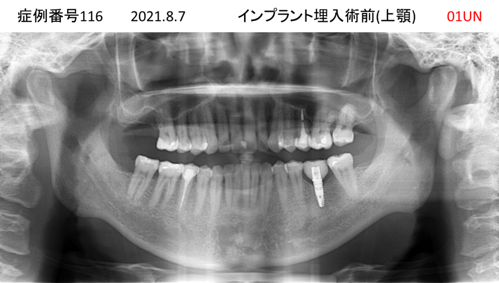 インプラント治療前