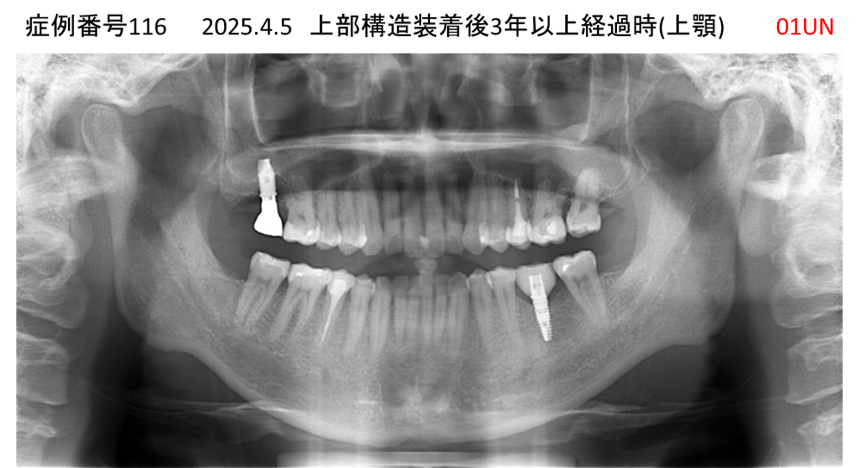 インプラント治療後