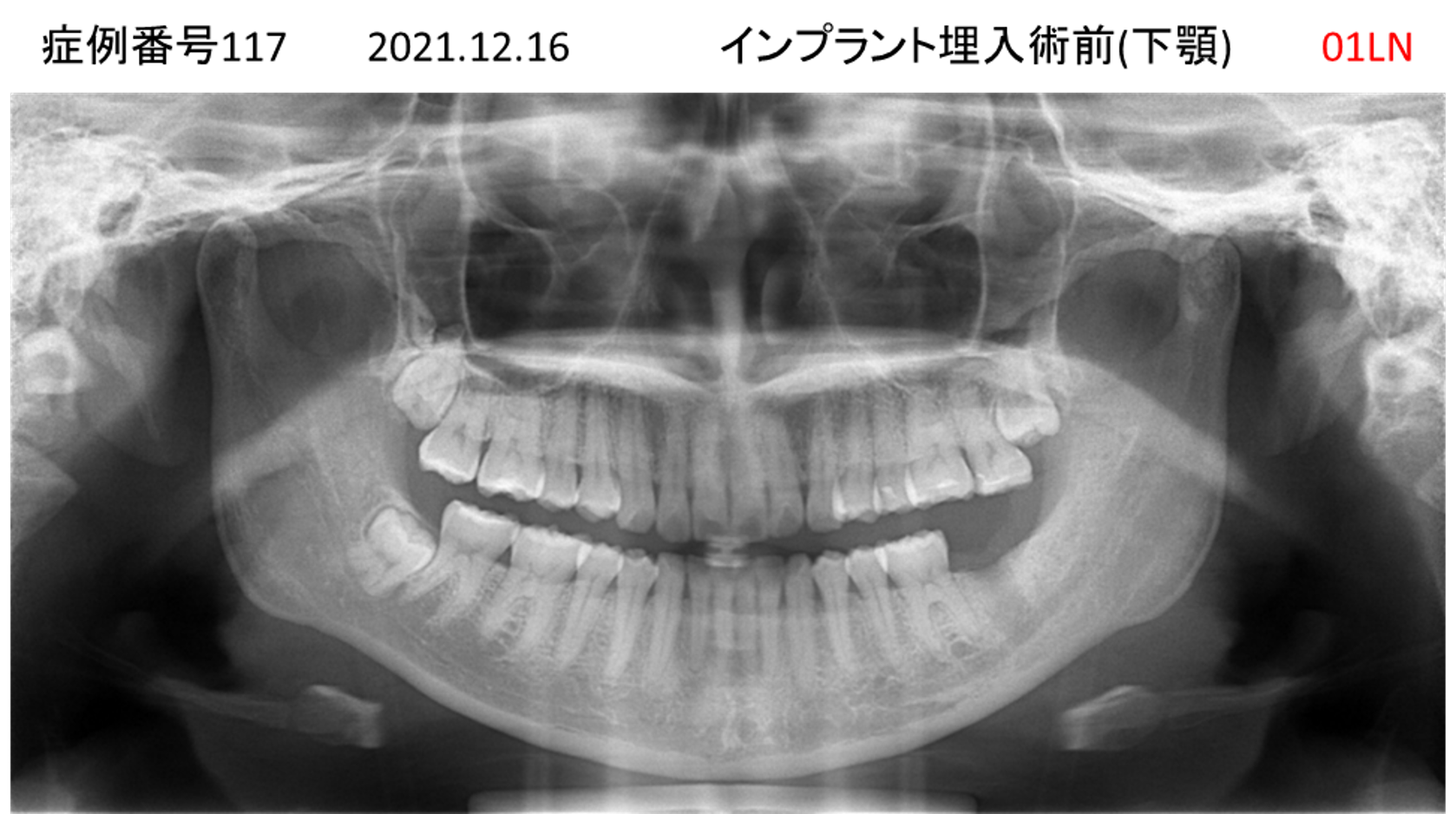 インプラント治療前