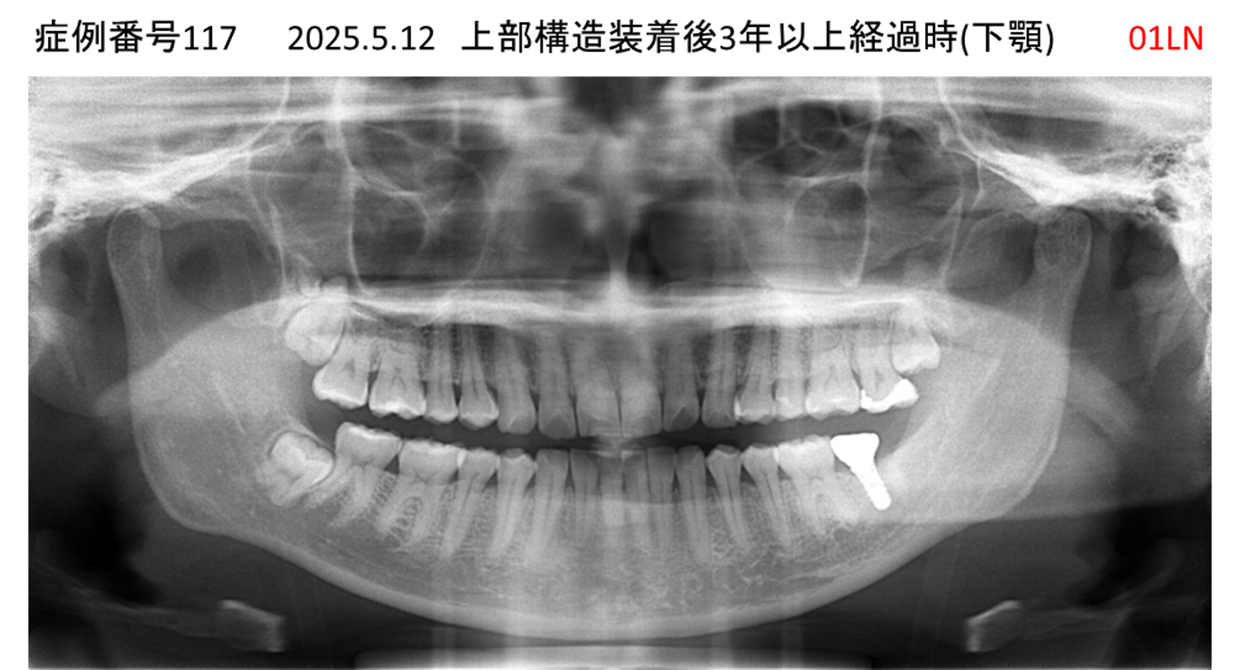 インプラント治療後