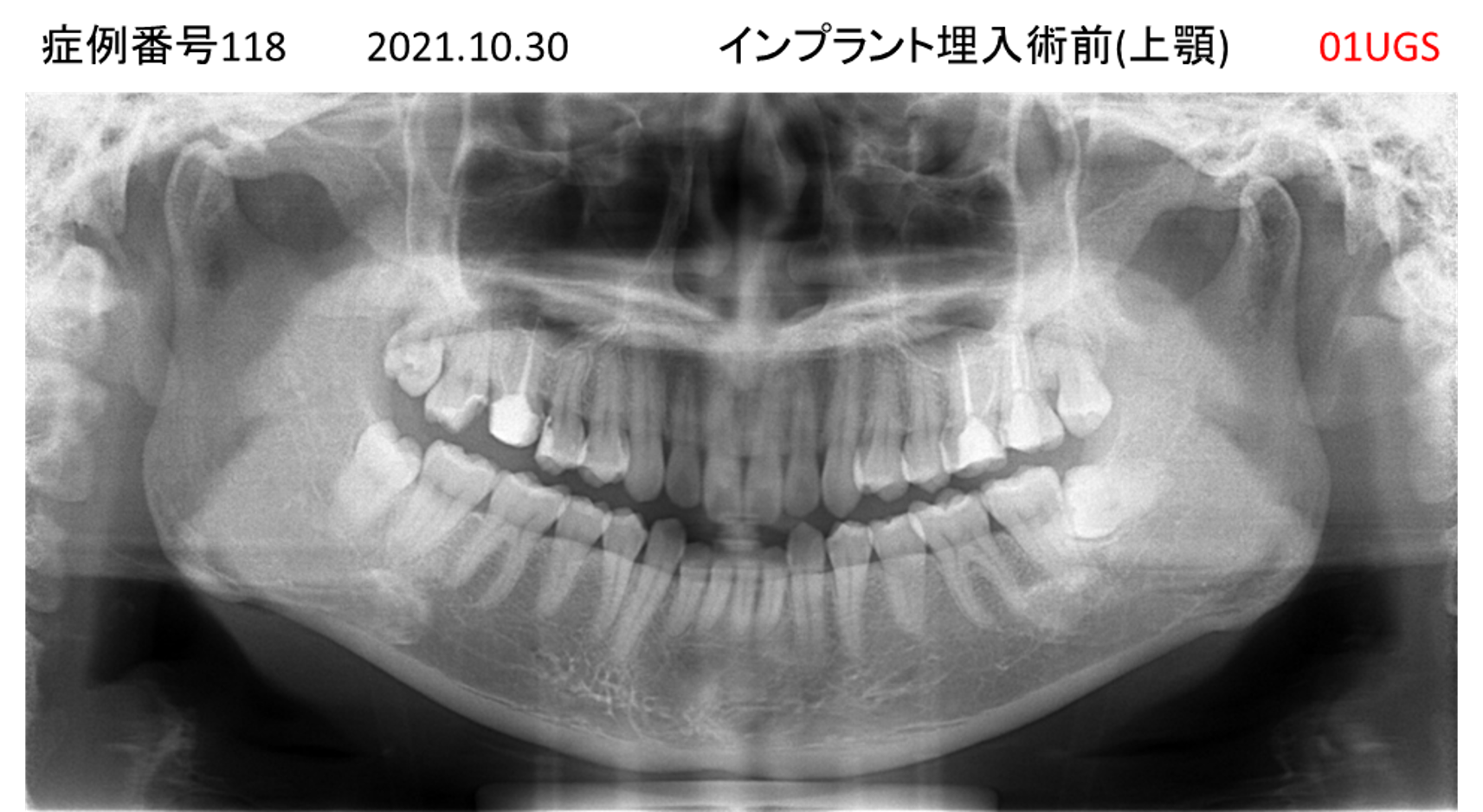 インプラント治療前