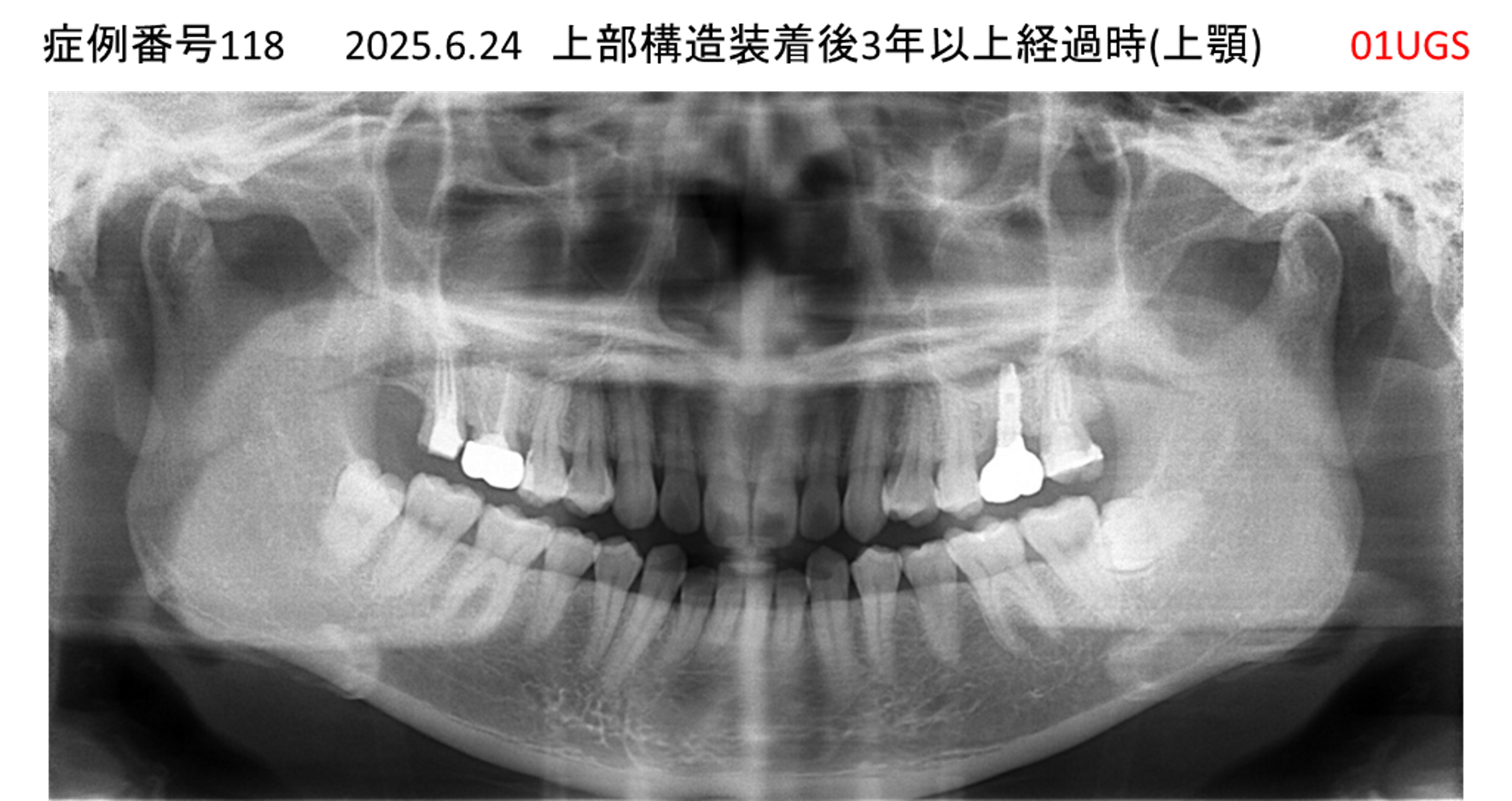 インプラント治療後