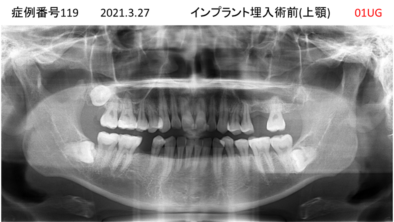 インプラント治療前