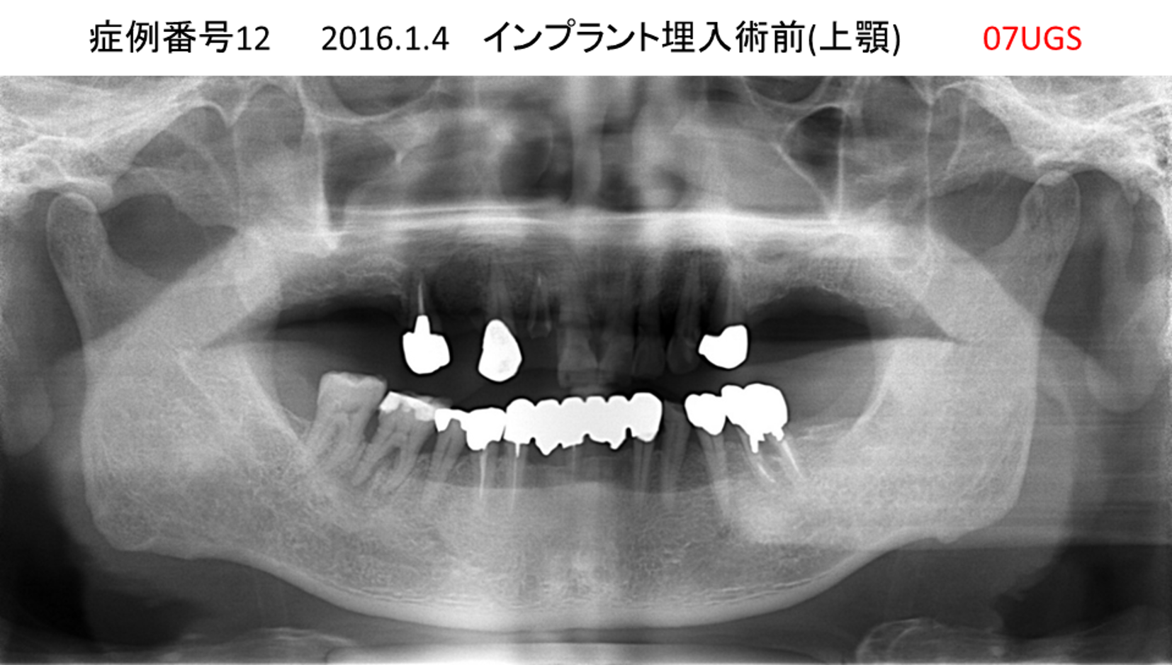 インプラント治療前