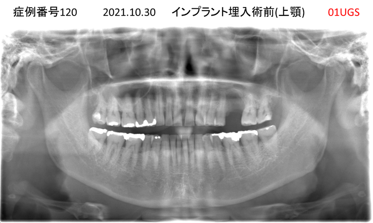 インプラント治療前