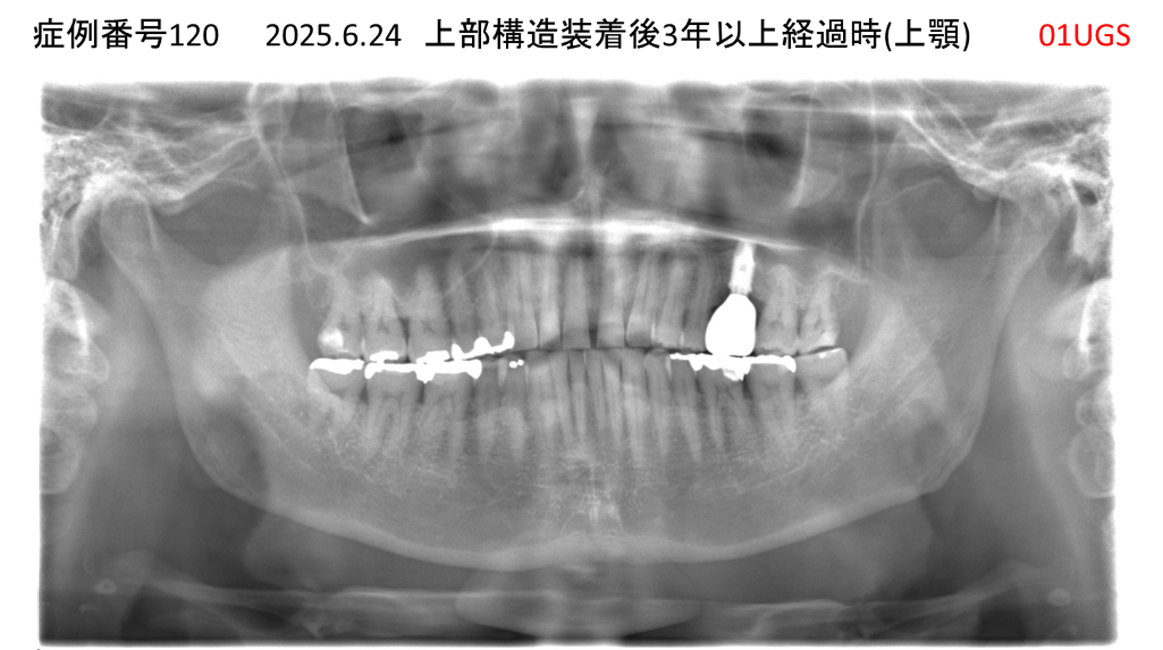 インプラント治療後