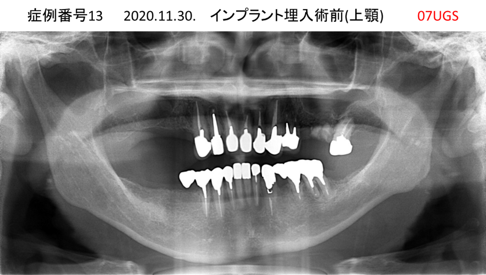 インプラント治療前