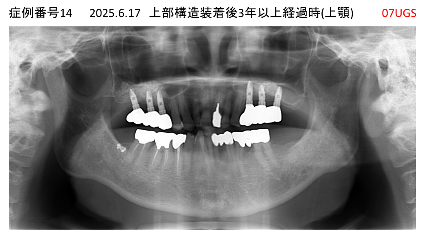 インプラント治療後