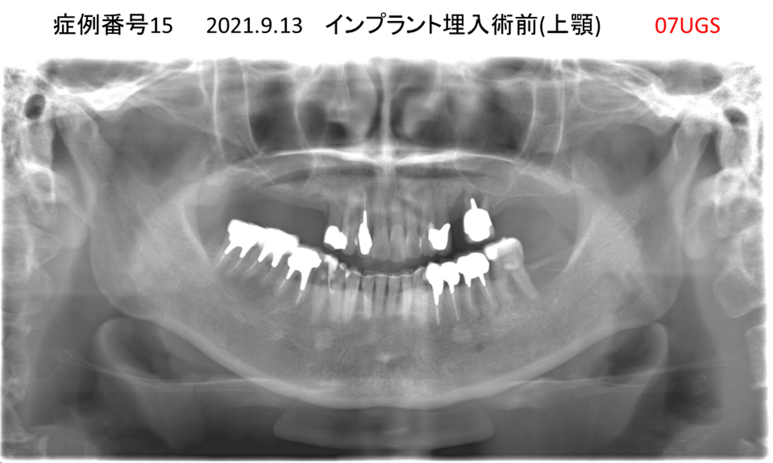 インプラント治療前