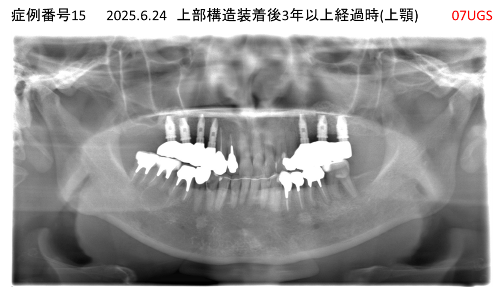 インプラント治療後