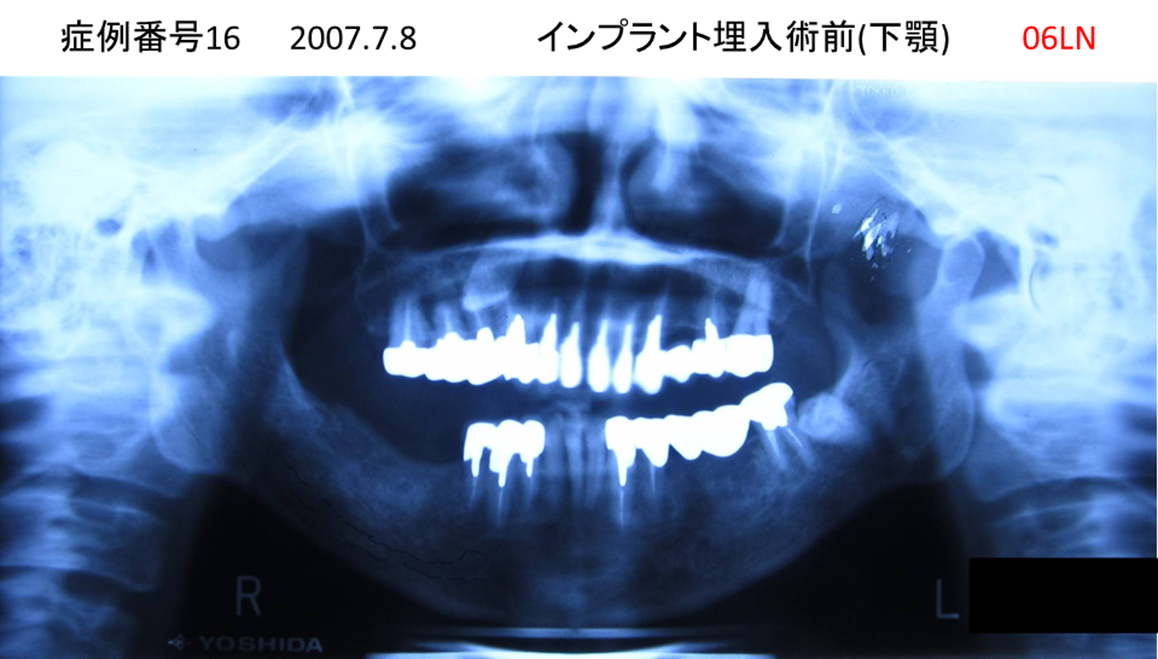 インプラント治療前