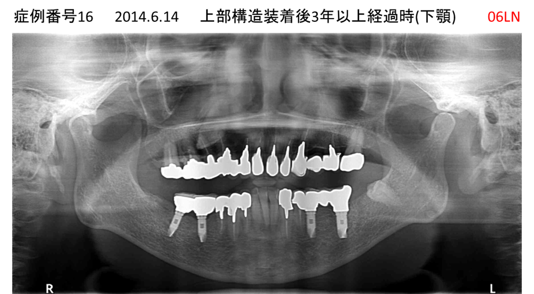 インプラント治療後