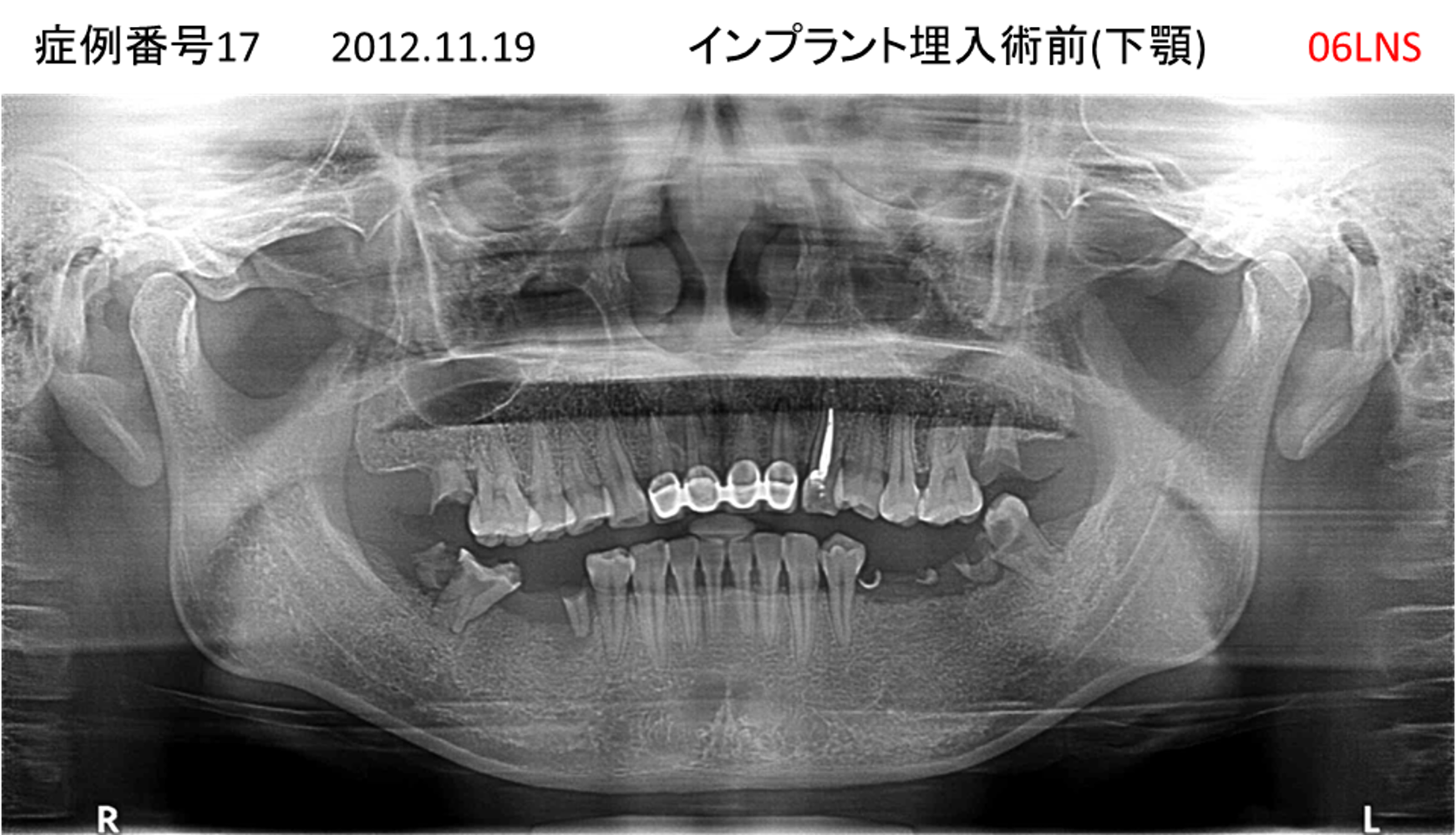 インプラント治療前