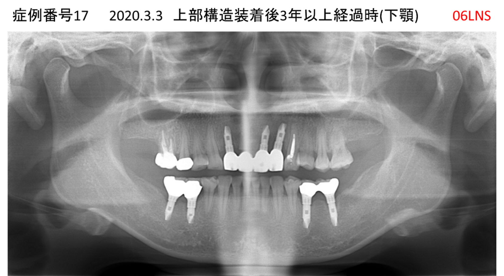 インプラント治療後